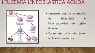 LEUCEMIA LINFOBLASTICA AGUDA
• Leucemia que se acompaña
de hiperplasia e
hiperreactividad del tejido
linfoide.
• Forma más común de cáncer
en la edad pediátrica.
 