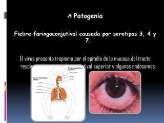 Patogenia
Fiebre faringoconjutival causada por serotipos 3, 4 y
7.
El virus presenta tropismo por el epitelio de la mucosa del tracto
respiratorio superior, la conjuntival superior y algunas endosomas.
 