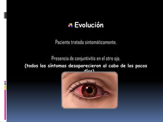 Evolución
Paciente tratada sintomáticamente.
Presencia de conjuntivitis en el otro ojo.
(todos los síntomas desaparecieron al cabo de los pocos
días)
 