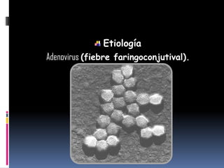 Etiología
Adenovirus (fiebre faringoconjutival).
 