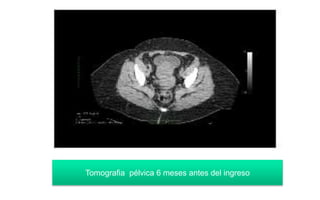 Tomografia pélvica 6 meses antes del ingreso
 