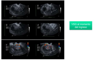 VSG al momento
del ingreso
 