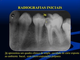 RADIOGRAFIAS INICIAIS
                                  36




36 apresentou um quadro clínico de ampla cavidade de cárie ...