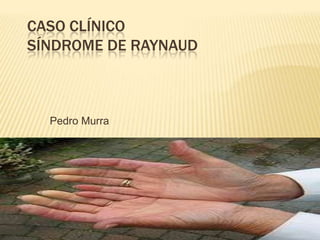 CASO CLÍNICO
SÍNDROME DE RAYNAUD



  Pedro Murra
 