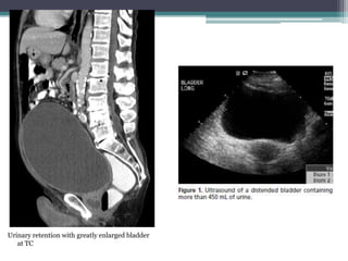 Urinary retention with greatly enlarged bladder
   at TC
 