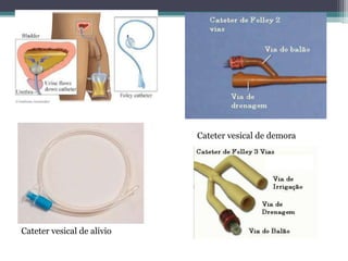 Cateter vesical de demora




Cateter vesical de alívio
 