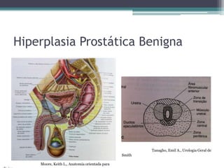 Hiperplasia Prostática Benigna
• Anatomia da próstata




                                                         Tanagho, Emil A., Urologia Geral de
                                                 Smith

      Moore, Keith L., Anatomia orientada para
 