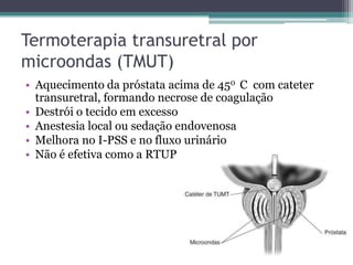 Termoterapia transuretral por
microondas (TMUT)
• Aquecimento da próstata acima de 450 C com cateter
  transuretral, formando necrose de coagulação
• Destrói o tecido em excesso
• Anestesia local ou sedação endovenosa
• Melhora no I-PSS e no fluxo urinário
• Não é efetiva como a RTUP
 