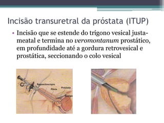 Incisão transuretral da próstata (ITUP)
 • Incisão que se estende do trígono vesical justa-
   meatal e termina no veromontanum prostático,
   em profundidade até a gordura retrovesical e
   prostática, seccionando o colo vesical
 