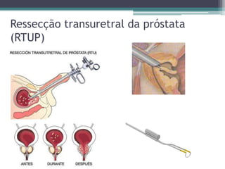 Ressecção transuretral da próstata
(RTUP)
 