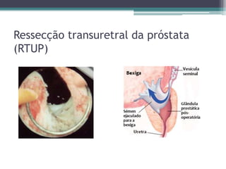 Ressecção transuretral da próstata
(RTUP)
 