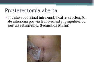 Prostatectomia aberta
• Incisão abdominal infra-umbilical e enucleação
  do adenoma por via transvesical suprapúbica ou
  por via retropúbica (técnica de Millin)
 