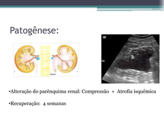 Patogênese:




•Alteração do parênquima renal: Compressão + Atrofia isquêmica

•Recuperação: 4 semanas
 