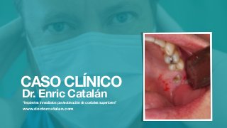 CASO CLÍNICO
Dr. Enric Catalán
“Implantes inmediatos postextracción de cordales superiores”
!
www.doctorcatalan.com
 
