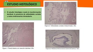 Universidad Nacional
Federico Villarreal
ESTUDIO HISTOLÓGICO
 El estudio histológico revela la transformación
decidual, la presencia de vellosidades coriales
y restos embrionarios intratubario.
 