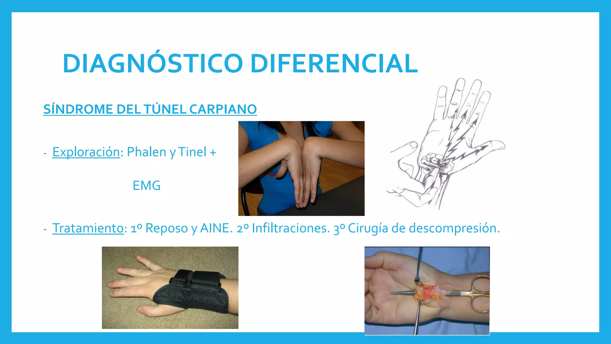 DIAGNÓSTICO DIFERENCIAL
SÍNDROME DELTÚNEL CARPIANO
- Exploración: Phalen yTinel +
EMG
- Tratamiento: 1º Reposo y AINE. 2º Infiltraciones. 3º Cirugía de descompresión.
 