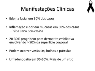 Manifestações Clínicas
• Edema facial em 50% dos casos

• Inflamação e dor em mucosas em 50% dos casos
   – Sítio único, sem erosão

• 20-30% progridem para dermatite esfoliativa
  envolvendo > 90% da superfície corporal

• Podem ocorrer vesículas, bolhas e pústulas

• Linfadenopatia em 30-60%. Mais de um sítio
 