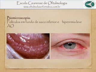 Escola Cearense de Oftalmologia
www.oftalmolaserfortaleza.com.br
Biomicroscopia:
Folículos em fundo de saco inferior e hiperemia leve
AO
 
