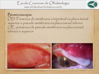 Escola Cearense de Oftalmologia
www.oftalmolaserfortaleza.com.br
Biomicroscopia:
OD: Presença de membrana conjuntival na placa tarsal
superior e pseudo membrana na placa tarsal inferior
OE: presença de pseudo membrana na placa tarsal
inferior e superior
 