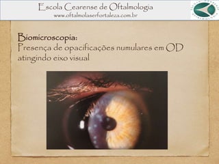 Biomicroscopia:
Presença de opacificações numulares em OD
atingindo eixo visual
Escola Cearense de Oftalmologia
www.oftalmolaserfortaleza.com.br
 