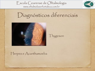 Diagnósticos diferenciais
Thygeson
Herpes e Acanthamoeba
Escola Cearense de Oftalmologia
www.oftalmolaserfortaleza.com.br
 