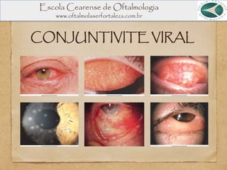 CONJUNTIVITE VIRAL
Escola Cearense de Oftalmologia
www.oftalmolaserfortaleza.com.br
 