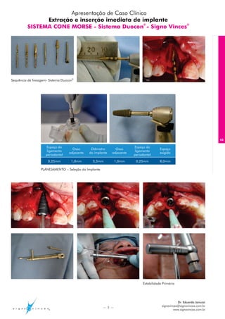 Apresentação de Caso Clínico
               Extração e inserção imediata de implante
         SISTEMA CONE MORSE - Sistema Duocon - Signo Vinces®
                                                  ®




Sequência de fresagem- Sistema Duocon®




                                                                                                                            03

                     Espaço do                                           Espaço do
                                     Osso       Diâmetro       Osso                       Espaço
                      ligamento                                           ligamento
                                   adjacente   do implante   adjacente                    exigido
                     periodontal                                         periodontal

                      0,25mm        1,0mm        5,5mm         1,0mm      0,25mm          8,0mm

                  PLANEJAMENTO – Seleção do Implante




                                                                               Estabilidade Primária




                                                                                                      Dr. Eduardo Januzzi
                                                       — 3 —
                                                                                           signovinces@signovinces.com.br
                                                                                                   www.signovinces.com.br
 