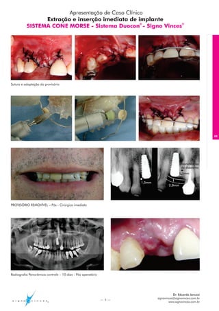 Apresentação de Caso Clínico
                Extração e inserção imediata de implante
          SISTEMA CONE MORSE - Sistema Duocon - Signo Vinces®
                                                   ®




Sutura e adaptação do provisório




                                                                                                              05




                                                                                             Manutenção
                                                                                             do diastema
                                                                                            1,5mm

                                                                     1,5mm
                                                                                     2,0mm




PROVISÓRIO REMOVÍVEL – Pós - Cirúrgico imediato




Radiografia Panorâmica controle – 10 dias - Pós operatório




                                                                                        Dr. Eduardo Januzzi
                                                             — 5 —
                                                                             signovinces@signovinces.com.br
                                                                                     www.signovinces.com.br
 