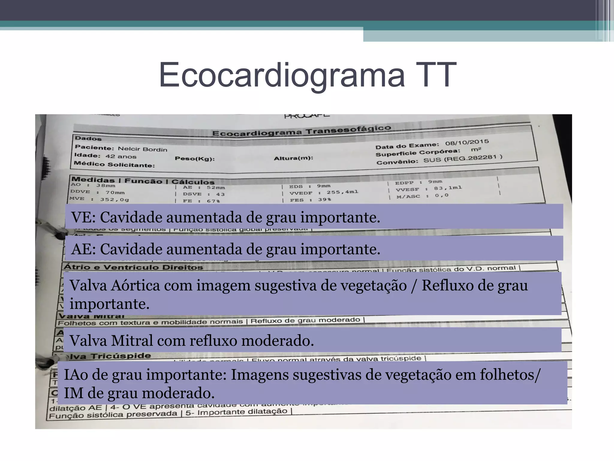 Ecocardiograma TT
VE: Cavidade aumentada de grau importante.
AE: Cavidade aumentada de grau importante.
Valva Aórtica com imagem sugestiva de vegetação / Refluxo de grau
importante.
Valva Mitral com refluxo moderado.
IAo de grau importante: Imagens sugestivas de vegetação em folhetos/
IM de grau moderado.
 