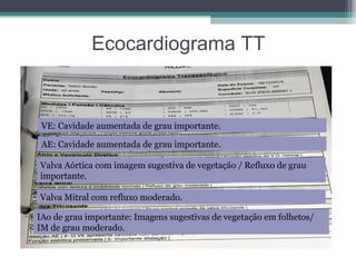 Ecocardiograma TT
VE: Cavidade aumentada de grau importante.
AE: Cavidade aumentada de grau importante.
Valva Aórtica com imagem sugestiva de vegetação / Refluxo de grau
importante.
Valva Mitral com refluxo moderado.
IAo de grau importante: Imagens sugestivas de vegetação em folhetos/
IM de grau moderado.
 