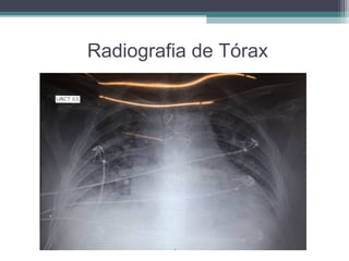 Radiografia de Tórax
 