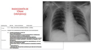 RADIOGRAFÍA DE
TÓRAX
(06/03/2023)
 