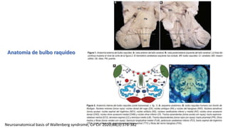 Anatomia de bulbo raquideo
Neuroanatomical basis of Wallenberg syndrome, Cir Cir. 2020;88(3):376-382
 