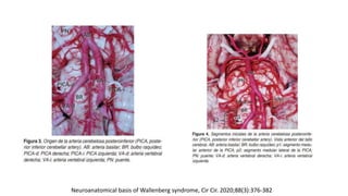 Neuroanatomical basis of Wallenberg syndrome, Cir Cir. 2020;88(3):376-382
 