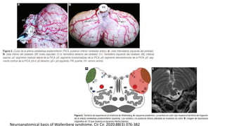 Neuroanatomical basis of Wallenberg syndrome, Cir Cir. 2020;88(3):376-382
 