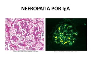 NEFROPATIA POR IgA

 