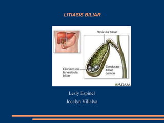 LITIASIS BILIAR
Lesly Espinel
Jocelyn Villalva
 