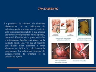 TRATAMIENTO
La presencia de cálculos sin síntomas
abdominales no es indicación de
colecistectomía, a menos que el paciente
esté inmunocomprometido o que existan
elementos predisponentes de malignidad,
como calcificación de la pared vesicular
o antecedentes familiares de cáncer de la
vesícula biliar. Una vez que el paciente
con litiasis biliar comienza a tener
síntomas se indica la colecistectomía
programada. La indicación principal de
colecistectomía de urgencia es la
colecistitis aguda
 