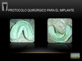 PROTOCOLO QUIRÚRGICO PARA EL IMPLANTE

 