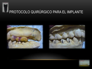 PROTOCOLO QUIRÚRGICO PARA EL IMPLANTE

 