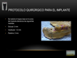PROTOCOLO QUIRÚRGICO PARA EL IMPLANTE
•

Se realizó el mapeo óseo en la zona
del implante dándonos las siguientes
medidas:

•

Oclusal: 3 mm

•

Vestibular: 1.5 mm

•

Palatino: 2 mm

 