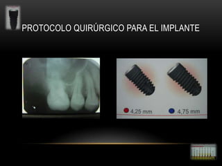 PROTOCOLO QUIRÚRGICO PARA EL IMPLANTE

 