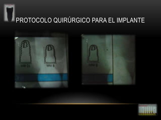 PROTOCOLO QUIRÚRGICO PARA EL IMPLANTE

 