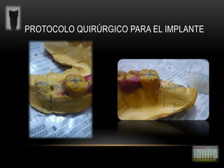 PROTOCOLO QUIRÚRGICO PARA EL IMPLANTE

 