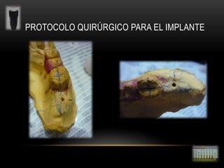 PROTOCOLO QUIRÚRGICO PARA EL IMPLANTE

 