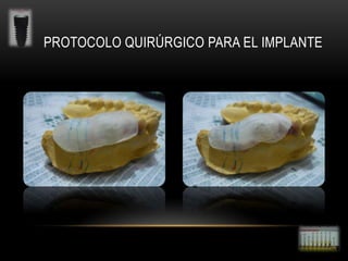 PROTOCOLO QUIRÚRGICO PARA EL IMPLANTE

 