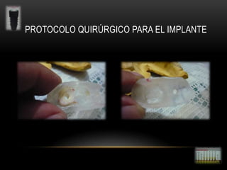 PROTOCOLO QUIRÚRGICO PARA EL IMPLANTE

 