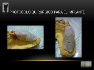 PROTOCOLO QUIRÚRGICO PARA EL IMPLANTE

 