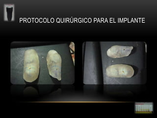 PROTOCOLO QUIRÚRGICO PARA EL IMPLANTE

 