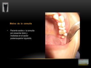 Motivo de la consulta
•

Paciente asiste a la consulta
por presentar dolor y
molestias en el sector
posterosuperior izquierdo.

 